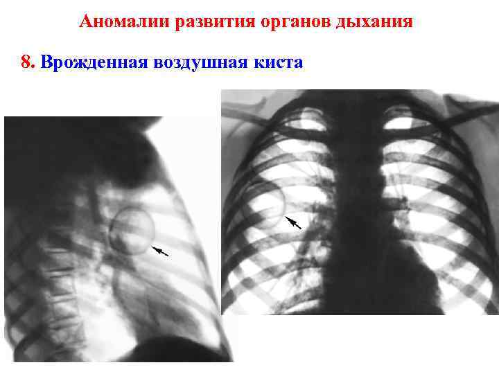 Аномалии развития органов дыхания 8. Врожденная воздушная киста 