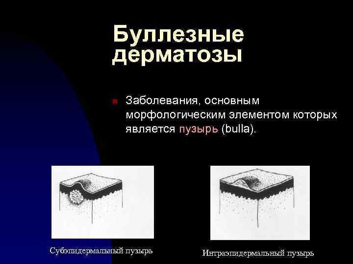 Буллезные дерматозы n Заболевания, основным морфологическим элементом которых является пузырь (bulla). Субэпидермальный пузырь Интраэпидермальный