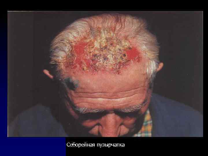 Себорейная пузырчатка 