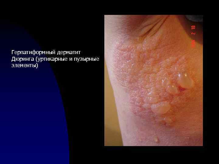 Герпатиформный дерматит Дюринга (уртикарные и пузырные элементы) 
