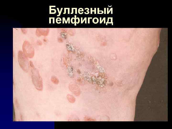Буллезный пемфигоид 