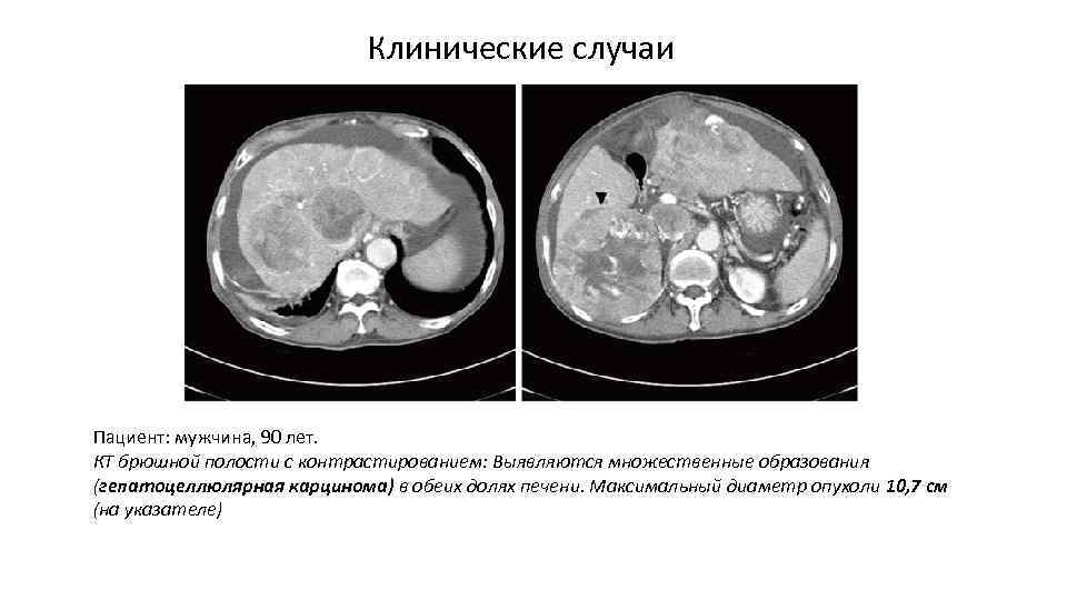 Клинические случаи Пациент: мужчина, 90 лет. КТ брюшной полости с контрастированием: Выявляются множественные образования