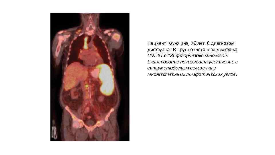 Пациент: мужчина, 76 лет. С диагнозом диффузная B-крупноклеточная лимфома ПЭТ-КТ с 18 f-фтордезоксиглюкозой: Сканирование