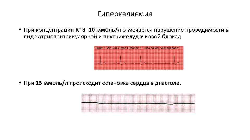 Гиперкалиемия • При концентрации К+ 8– 10 ммоль/л отмечается нарушение проводимости в виде атриовентрикулярной