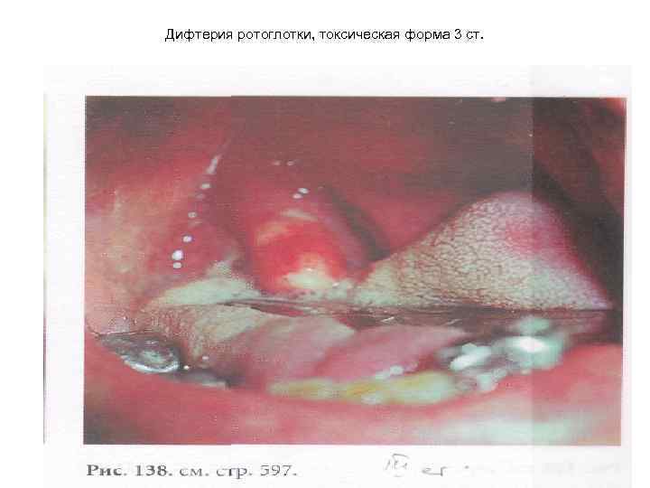 Дифтерия ротоглотки, токсическая форма 3 ст. 