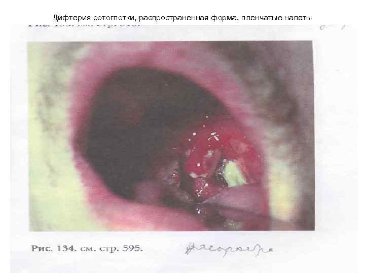 Дифтерия ротоглотки, распространенная форма, пленчатые налеты 