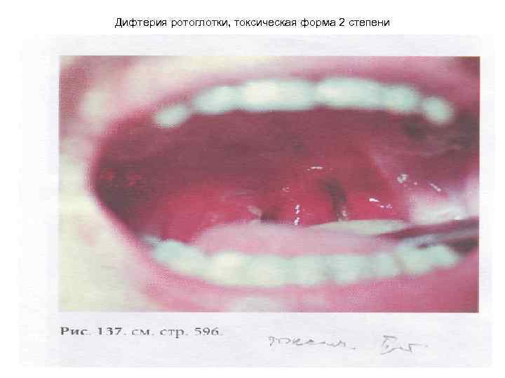 План обследования при дифтерии