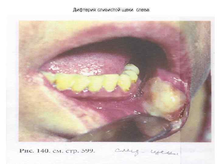 Дифтерия слизистой щеки слева 