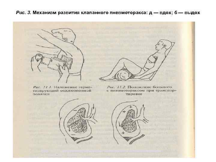 Рис. 3. Механизм развития клапанного пневмоторакса: д — вдох; 6 — выдох 