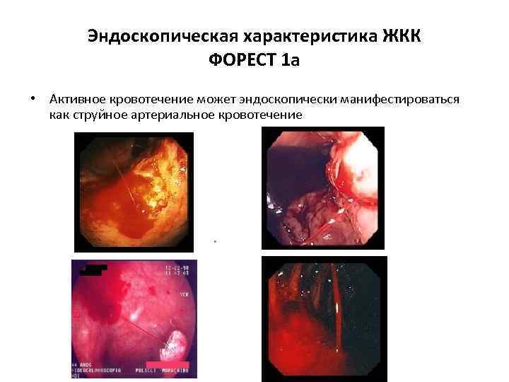 Эндоскопическая характеристика ЖКК ФОРЕСТ 1 а • Активное кровотечение может эндоскопически манифестироваться как струйное