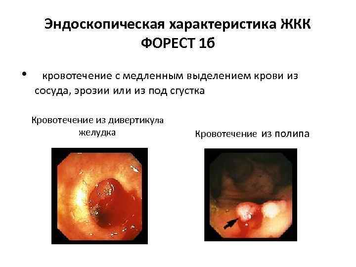 Эндоскопическая характеристика ЖКК ФОРЕСТ 1 б • кровотечение с медленным выделением крови из сосуда,