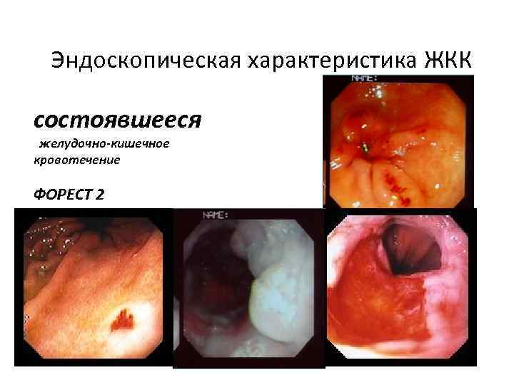 Эндоскопическая характеристика ЖКК состоявшееся желудочно-кишечное кровотечение ФОРЕСТ 2 