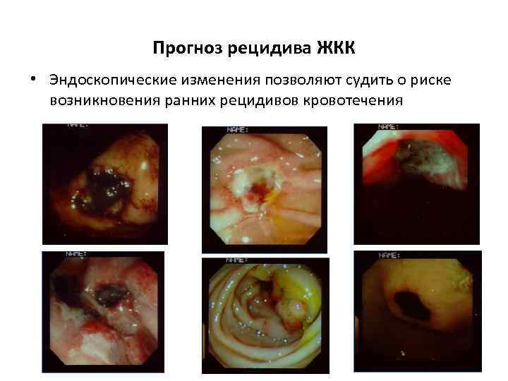 Прогноз рецидива ЖКК • Эндоскопические изменения позволяют судить о риске возникновения ранних рецидивов кровотечения