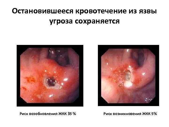 Остановившееся кровотечение из язвы угроза сохраняется Риск возобновления ЖКК 35 % Риск возникновения ЖКК