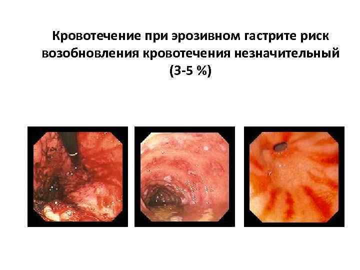 Кровотечение при эрозивном гастрите риск возобновления кровотечения незначительный (3 -5 %) 