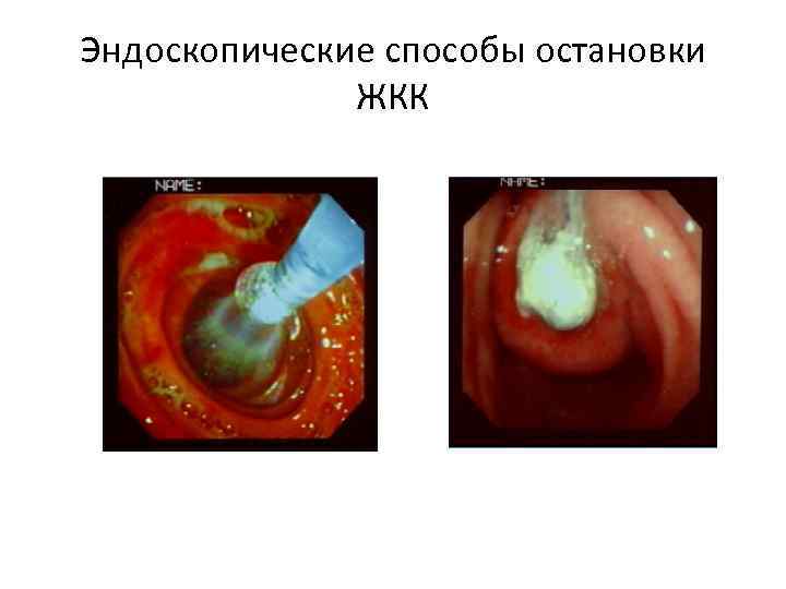 Эндоскопические способы остановки ЖКК 