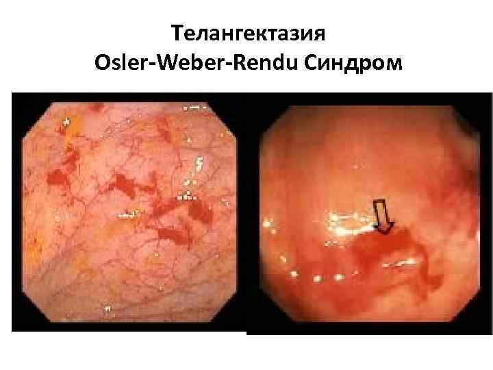 Телангектазия Osler-Weber-Rendu Синдром 