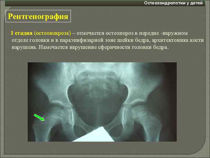 Остеохондропатии у детей Рентгенография 1 стадия (остеонекроза) – отмечается остеопороз в передне -наружном отделе