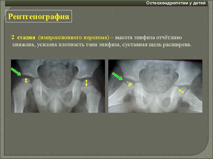 Остеохондропатии у детей Рентгенография 2 стадия (импрессионного перелома) – высота эпифиза отчётливо снижена, усилена