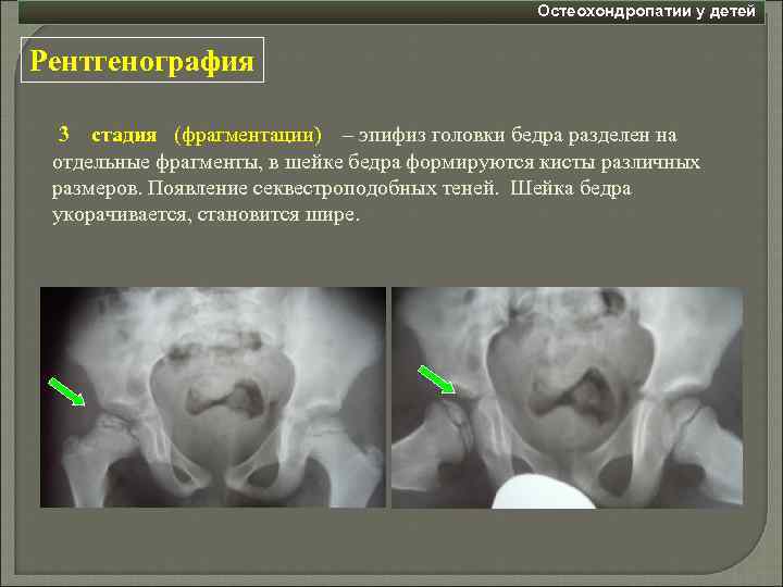 Остеохондропатии у детей Рентгенография 3 стадия (фрагментации) – эпифиз головки бедра разделен на отдельные