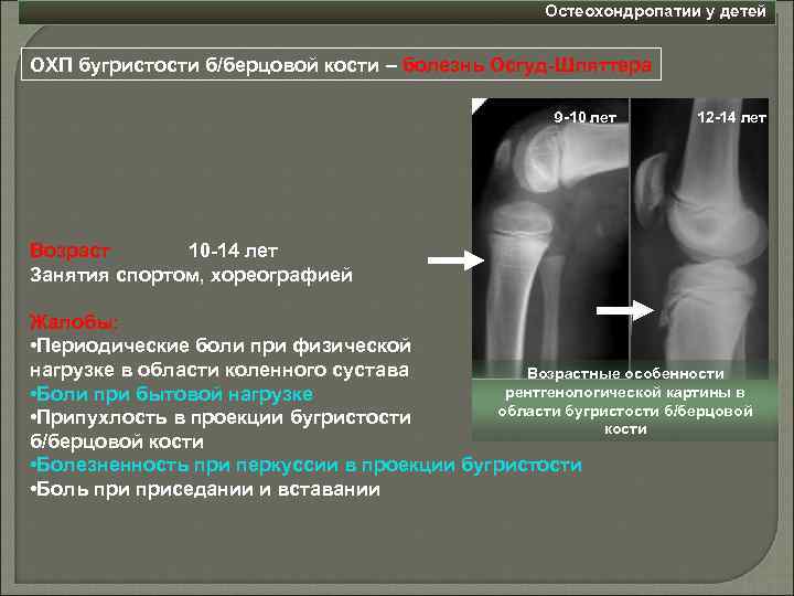 Остеохондропатии у детей ОХП бугристости б/берцовой кости – болезнь Осгуд-Шляттера 9 -10 лет 12