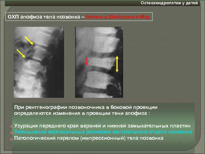 Остеохондропатии у детей ОХП апофиза тела позвонка – болезнь Шойэрмана-Мау При рентгенографии позвоночника в