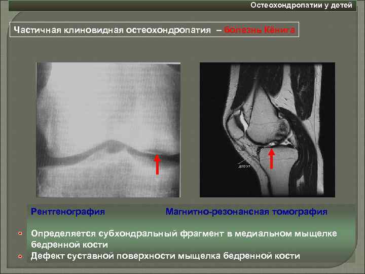 Остеохондропатии у детей Частичная клиновидная остеохондропатия – болезнь Кёнига Рентгенография Магнитно-резонансная томография Определяется субхондральный