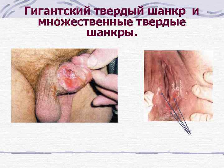 Гигантский твердый шанкр и множественные твердые шанкры. 