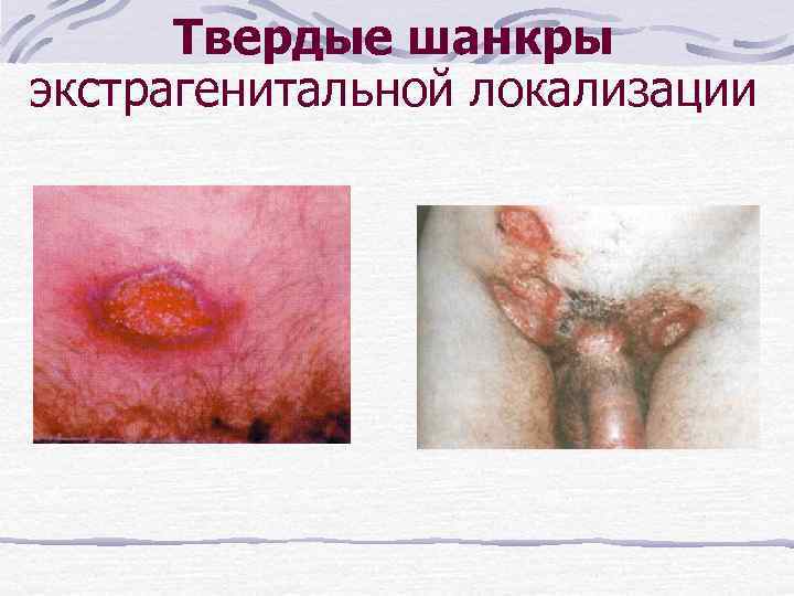 Твердые шанкры экстрагенитальной локализации 
