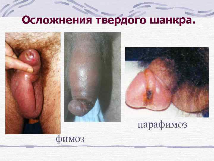 Осложнения твердого шанкра. парафимоз 