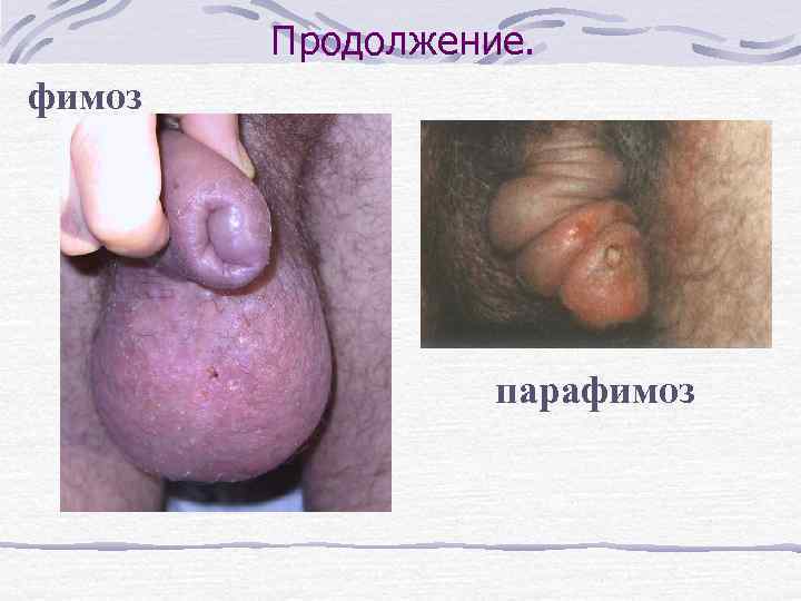 Продолжение. фимоз парафимоз 