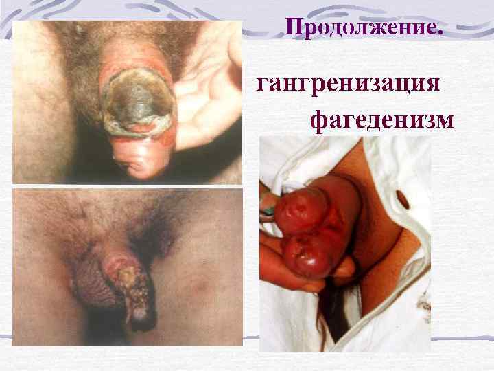 Продолжение. гангренизация фагеденизм 