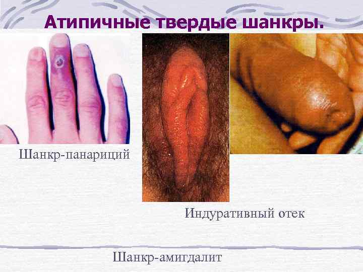 Атипичные твердые шанкры. Шанкр-панариций Индуративный отек Шанкр-амигдалит 