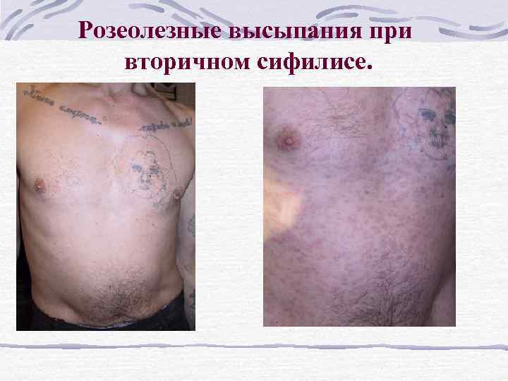 Розеолезные высыпания при вторичном сифилисе. 