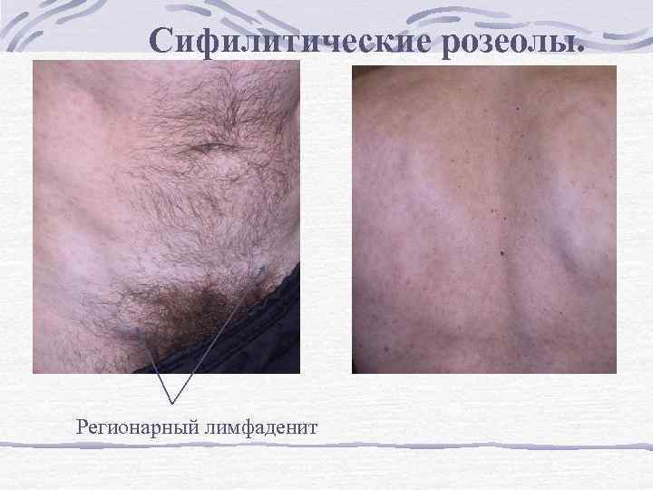Сифилитические розеолы. Регионарный лимфаденит 