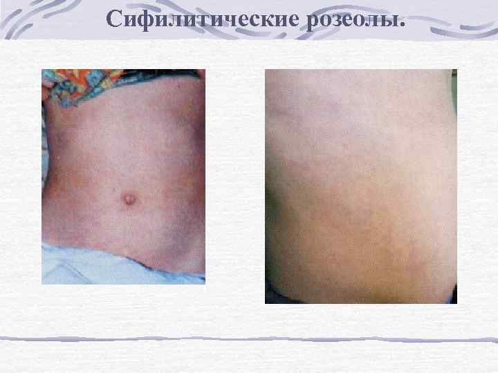 Сифилитические розеолы. 