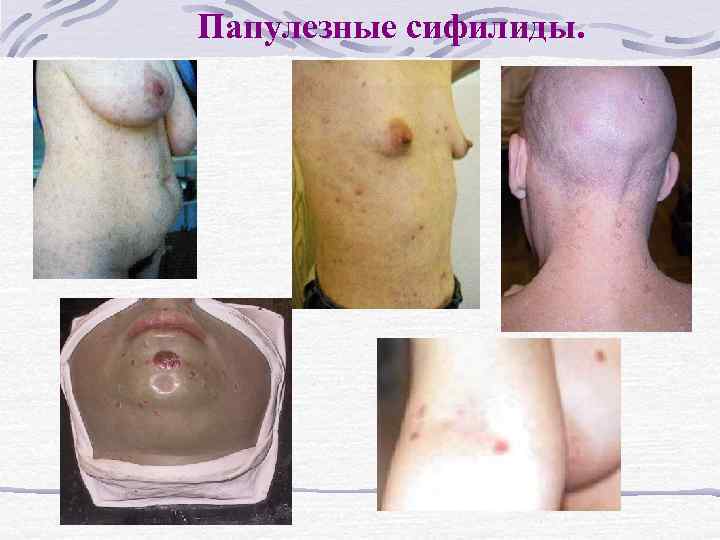 Папулезные сифилиды. 