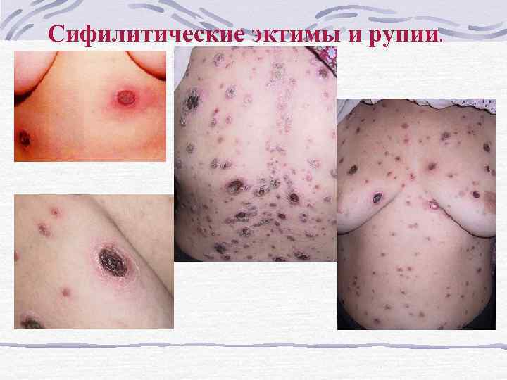 Сифилитические эктимы и рупии. 