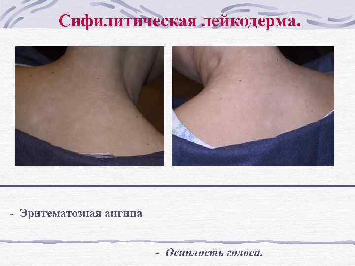 Сифилитическая лейкодерма. - Эритематозная ангина - Осиплость голоса. 