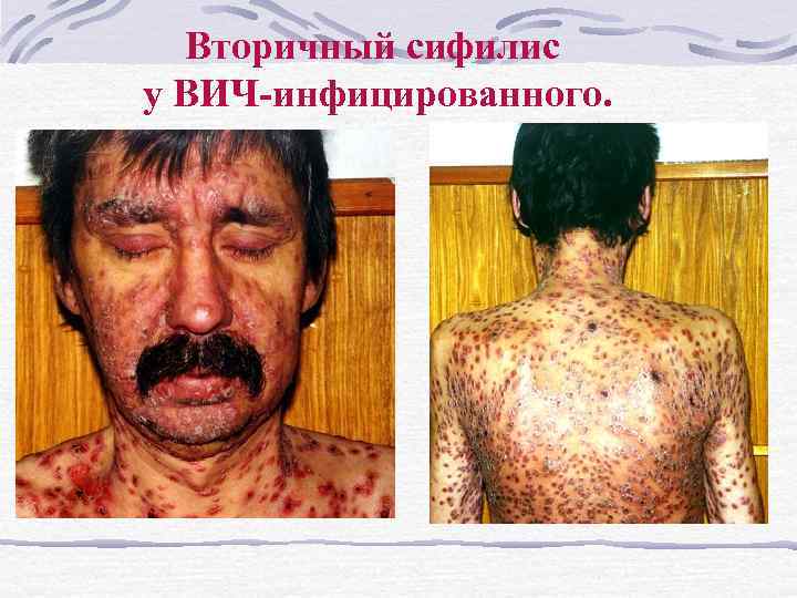Вторичный сифилис у ВИЧ-инфицированного. 