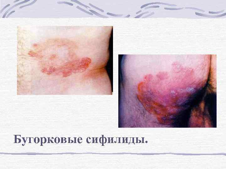Бугорковые сифилиды. 
