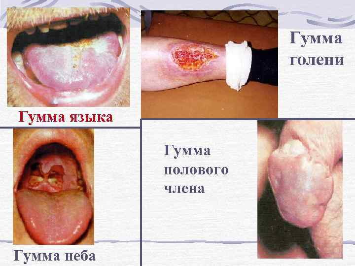 Гумма голени Гумма языка Гумма полового члена Гумма неба 