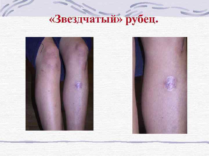  «Звездчатый» рубец. 