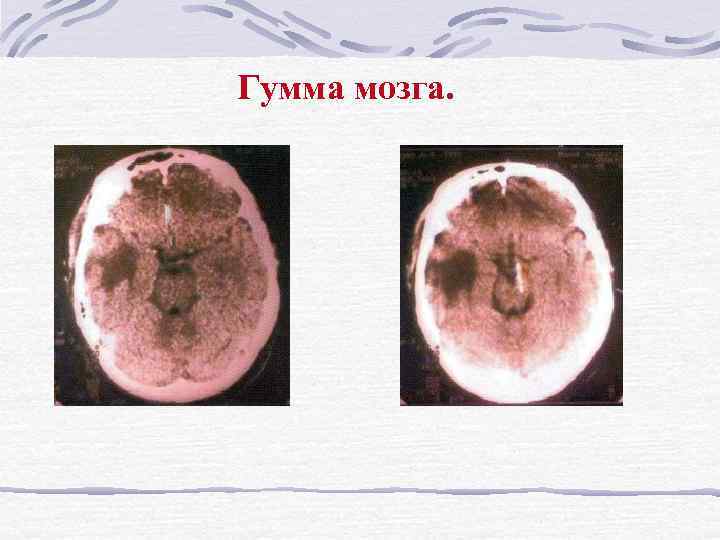 Гумма мозга. 