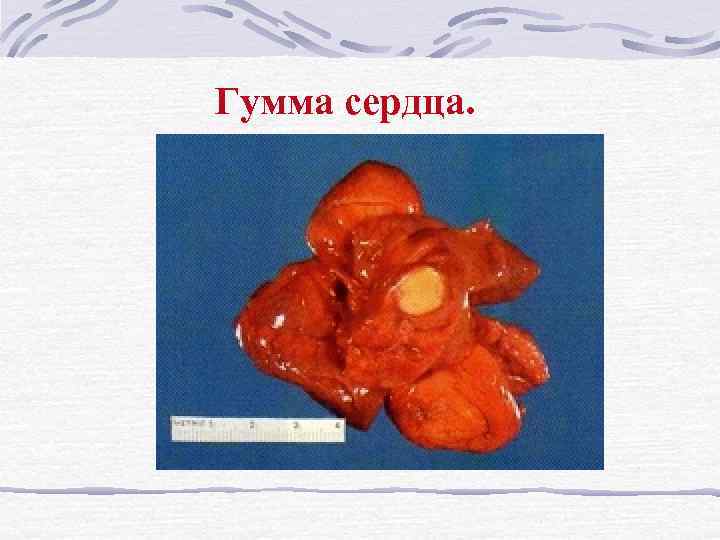 Гумма сердца. 