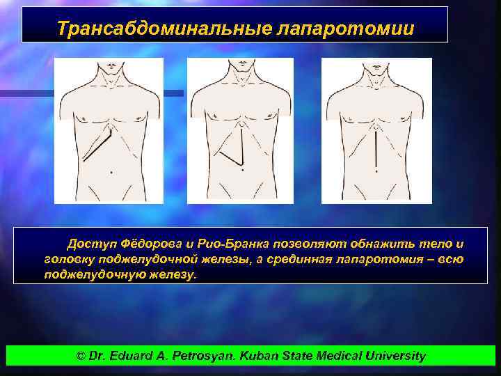 Трансабдоминальные лапаротомии Доступ Фёдорова и Рио-Бранка позволяют обнажить тело и головку поджелудочной железы, а