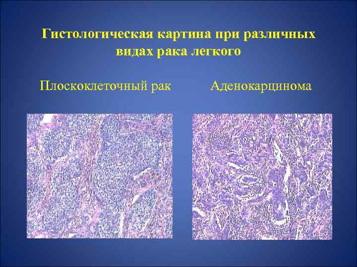 Гистологическая картина при различных видах рака легкого Плоскоклеточный рак Аденокарцинома 