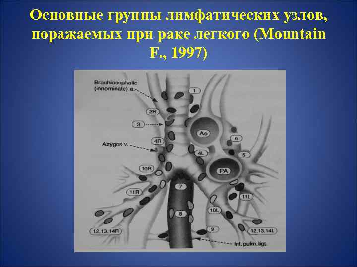 Основные группы лимфатических узлов, поражаемых при раке легкого (Mountain F. , 1997) 