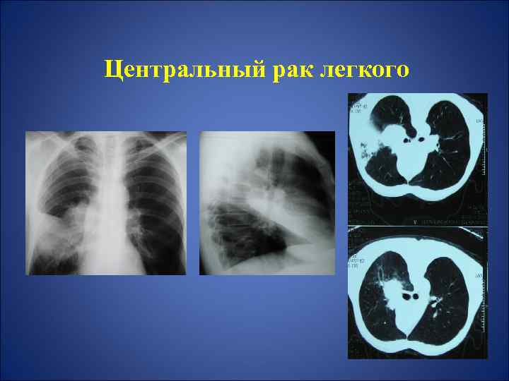 Признаки центрального рака легкого. Карцинома правого бронха. Центральная раковая.