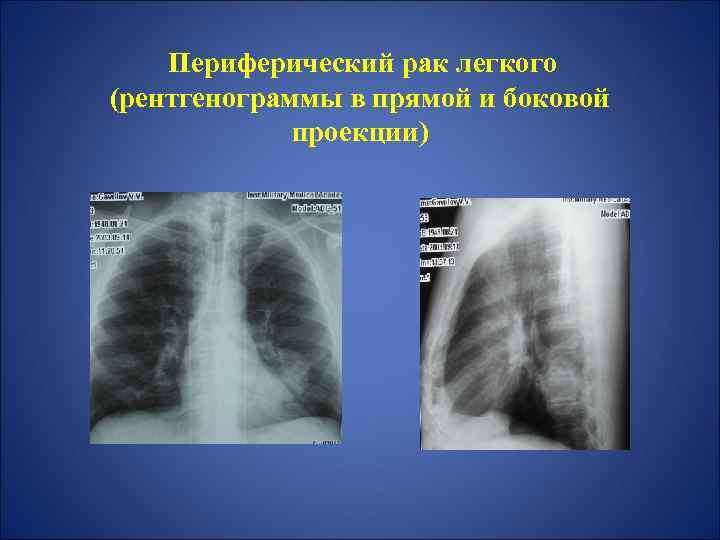 Периферический рак легкого (рентгенограммы в прямой и боковой проекции) 